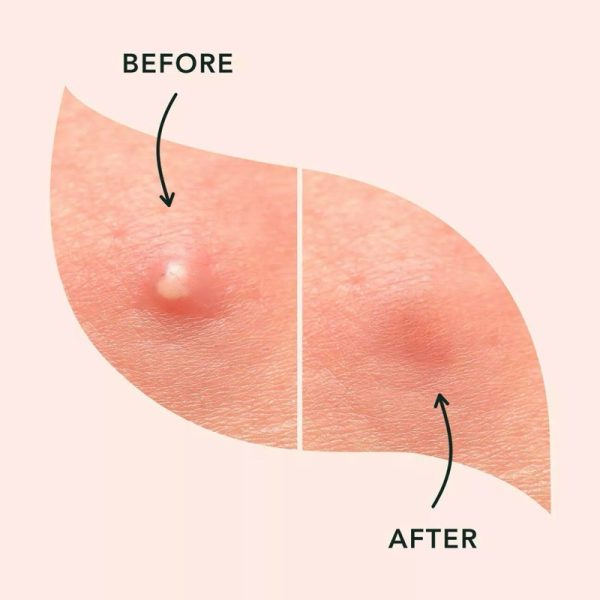 Royal Prestige Ultra Thin Acne Patch 72pcs patch jerawat tempelan jerawat acneway mymi acne patch